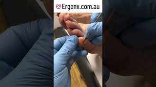 Little toe callus hard skin removal by podiatrist this makes the pinky toe more comfortable [upl. by Celestyn]