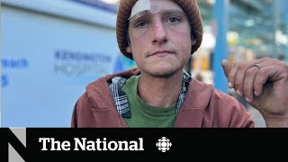 How a fleshrotting ‘zombie drug’ is complicating the overdose crisis [upl. by Rebhun]