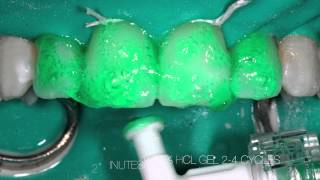 White spot treatment with DMG ICON [upl. by Ruder]