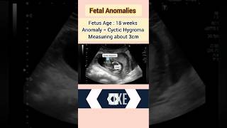 Fetal Anomaly ultrasound cyctic Hygromapregnancyultrasound medical baby [upl. by Weissmann]