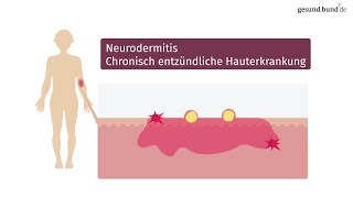 Was ist Neurodermitis und wie kann man sie behandeln [upl. by Llemmart]