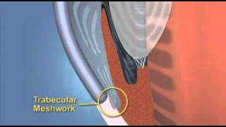 Primary Angle Closure Glaucoma Explained With Animation [upl. by Juno]