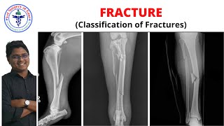 FRACTURE Classification  Lecture 02 I Orthopedics [upl. by Annayat]