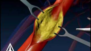 Carotid Endarectomy  3D Medical Animation [upl. by Ahsauqal]