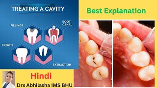 Cavity treatment  Root Canal Treatment Filling Tooth extension Flouride Treatment video in hindi [upl. by Lucais]