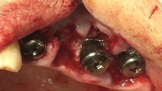 Immediate implantation for Mx full mouth reconstruction [upl. by Porcia]