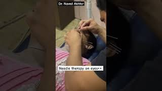 Dry needling on eyes  dryneedling therapy shorts [upl. by Adnawyek]