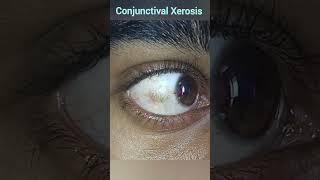 Xerophthalmia  Conjunctival Xerosis  Vitamin A Deficiencies [upl. by Eelek]