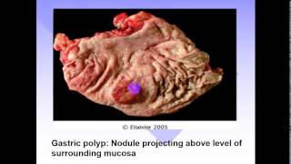 pathology  dr Dhaymaa  Stomach 2  Gastric Tumors اورام المعدة [upl. by Galatia]