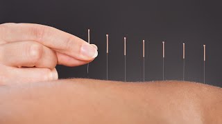 The Science Behind How Acupuncture Helps Relieve Pain A Doctor Of Chinese Medicine Explains [upl. by Aiepoissac510]