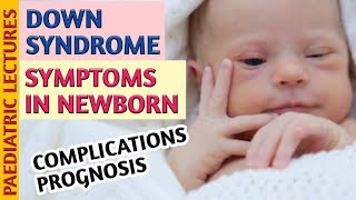 Down Syndrome Symptoms In Newborn Baby amp Child [upl. by Odnavres]