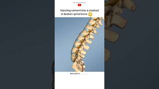 Vertebroplasty procedure short [upl. by Marcel118]