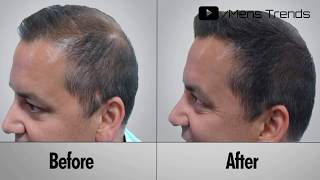 Derma Rolling For Hair Regrowth  Minoxidil  How To Use Derma Rolling System  Hair regrowth system [upl. by Uttasta]