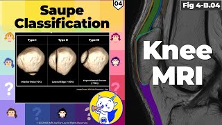 Fig 4B04 Bipartite Patella and Saupe Classification [upl. by Alton653]