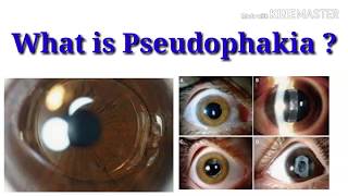 What is pseudophakia  sign  Intraocular lens  sharp vision [upl. by Alexandros]