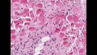 Histopathology StomachAdenocarcinoma linitis plastica [upl. by Capps]