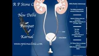 Animation of Kidney stone treatment by RIRS Flexible Ureteroscopy [upl. by Brady]