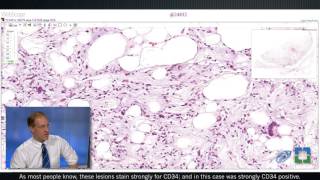 Pathology Insights WellDifferentiated Lipomatous Tumors with John Goldblum MD [upl. by Monto309]