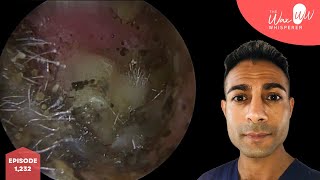 1232  Fungal Spore Ear Infection Cleaning [upl. by Leanora]