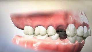 Removing Teeth for Braces  Why Extracting and Retracting Orthodontics is harmful [upl. by Ecarret]