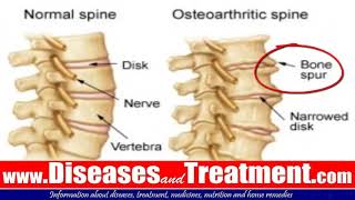 3 Osteophytes Bone Spur Causes Symptoms Diagnosis Treatment [upl. by Gersham]