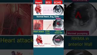 Heart attack vs Heart fail ecg  echo l ecg echo shorts [upl. by Milla]