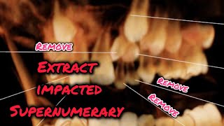 Remove Impacted Supernumerary Tooth with Sectioning [upl. by Nathalie551]