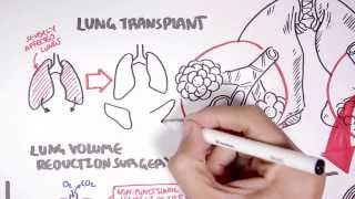 Emphysema Treatment [upl. by Kiah720]