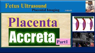 Fetus Ultrasound Placenta Accreta Part1 [upl. by Cusick]