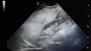 Échographie abdominale Stéatose hépatique diffuse Hepatomegalie FH a 215 mm [upl. by Attelra]