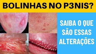 Bolinhas No Pênis Descubra Agora o Que Elas Realmente São [upl. by Guod]