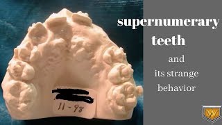 Supernumerary teeth and their strange behavior on developing dentition [upl. by Bessy]