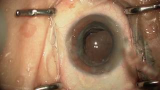 HD Zepto Cataract Surgery [upl. by Aicnelav]