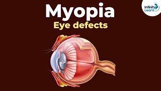 Eye defects  Myopia  Dont Memorise [upl. by Decca215]