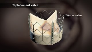 TAVI Transcatheter Aortic Valve Implantation [upl. by Oigile510]