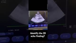 ECHOCARDIOGRAPHY  Identify the echo findings shown in clip [upl. by Hazmah]