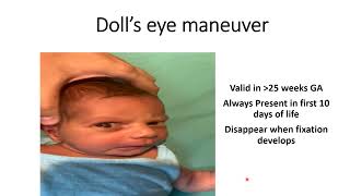 Dolls Eye Maneuver  Pediatrics [upl. by Elijah175]