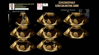 Schizencephaly [upl. by Dre]