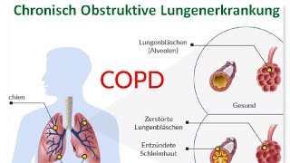 GOLDSkala zur Einschätzung der COPDchronisch  obstruktive Lungenerkrankung [upl. by Anselme]