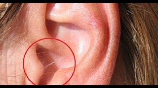 EAR HAIR IS THE FIRST WARNING SIGN OF THE MOST DANGEROUS DISEASE IN THE 21ST CENTURY [upl. by Atenaz674]