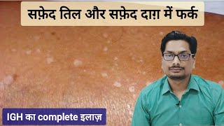 सफ़ेद तिल और सफ़ेद दाग़ में फर्क  Idiopathic Guttate Hypomelanosis  IGH vs Vitiligo vitiligo igh [upl. by Godliman]