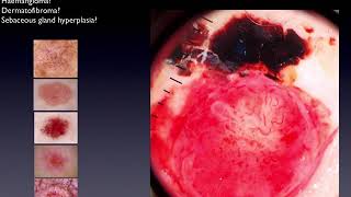 Red and Pink Lesions  Part 3  Dr Cliff Rosendahl [upl. by Averyl]