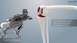 Mathys balanSys BICONDYLAR Knee System – Ligament Tensor [upl. by Ahsait]