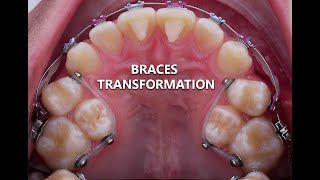 Braces transformation crooked teeth [upl. by Hadihahs122]