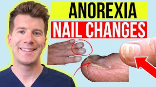 6 finger nail changes seen in ANOREXIA  Doctor explains [upl. by Horne]