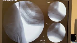 5th Metatarsal Fracture Repair Surgery [upl. by Harutak681]