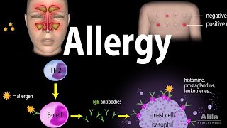 Allergy  Mechanism Symptoms Risk factors Diagnosis Treatment and Prevention Animation [upl. by Esineg]