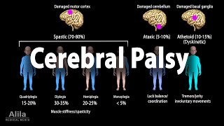 Cerebral Palsy Animation [upl. by Nalym]