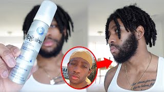 Why I Stopped Using Minoxidil  2 Year Beard Growth Journey [upl. by Lsil]