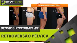 Retroversão Pélvica  Equilíbrio Pélvico  Desvios Posturais 7 [upl. by Eniotna51]